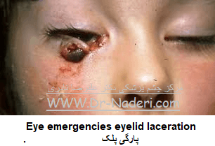  Eye emergencies  eyelid lacerationپارگی پلک